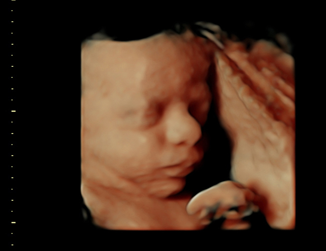 3D ultrasound image at 31 weeks
